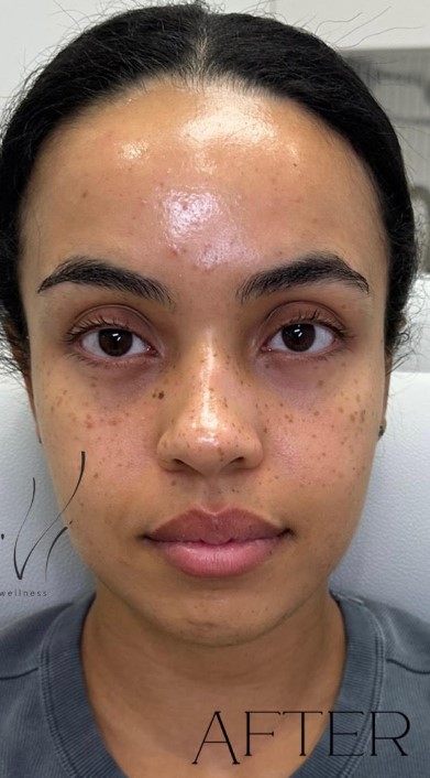 after facial balancing