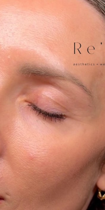 Before Brow Lumination