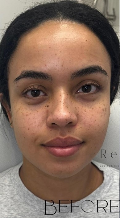 Before Facial Balancing