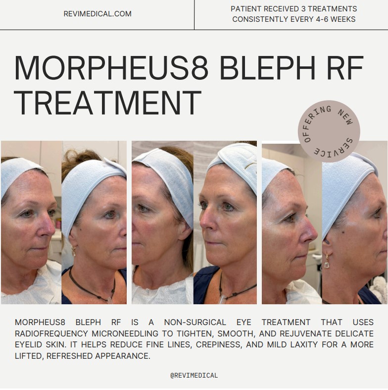 Morpheus8 Licensed Treatment